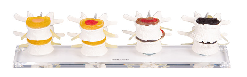 Modèle anatomique - Dégénérescence de la colonne lombaire haut de gamme