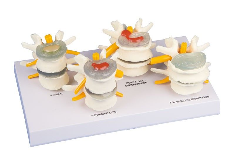 Modèle anatomique - Dégénérescence de la colonne en 4 stage sur socle