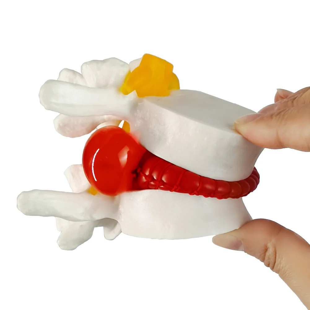 Anatomical model - Herniated disc simulator