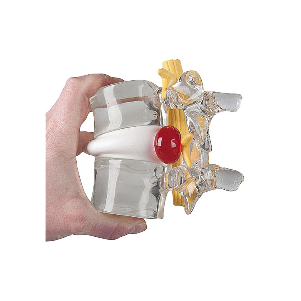 Anatomical model - Herniated disc simulator
